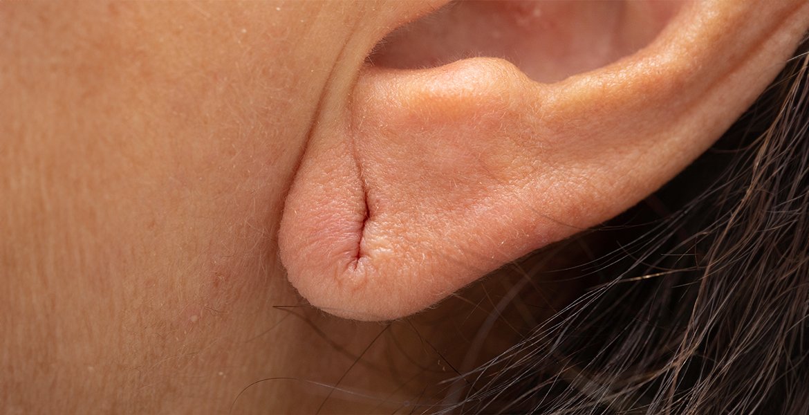 Ear Lobe Repair in Jaipur
