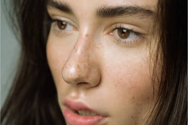 Freckels Removal in Jaipur