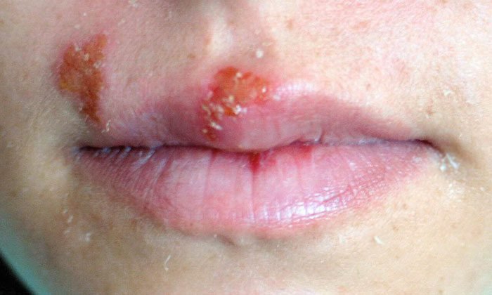 Herpes Infection treatment in Jaipur