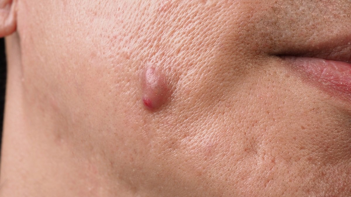 Skin Cyst Removal in Jaipur