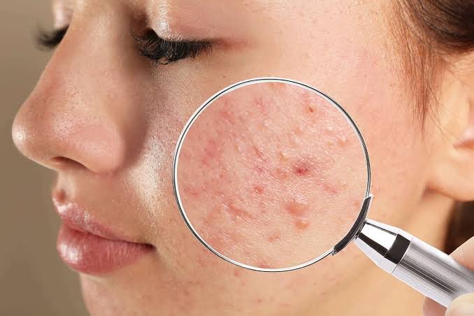 Acne Treatment in jaipur