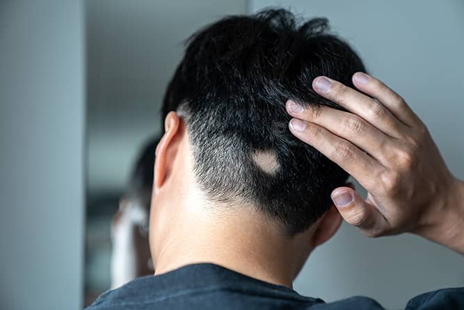 Alopecia Areata treatment in jaipur