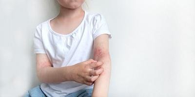Atopic Dermatitis Treatment in Jaipur