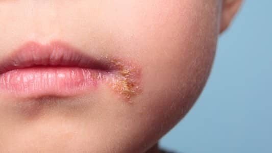 Bacterial Skin Infection treatment in Jaipur
