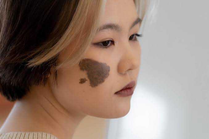 Birthmark Treatment in jaipur