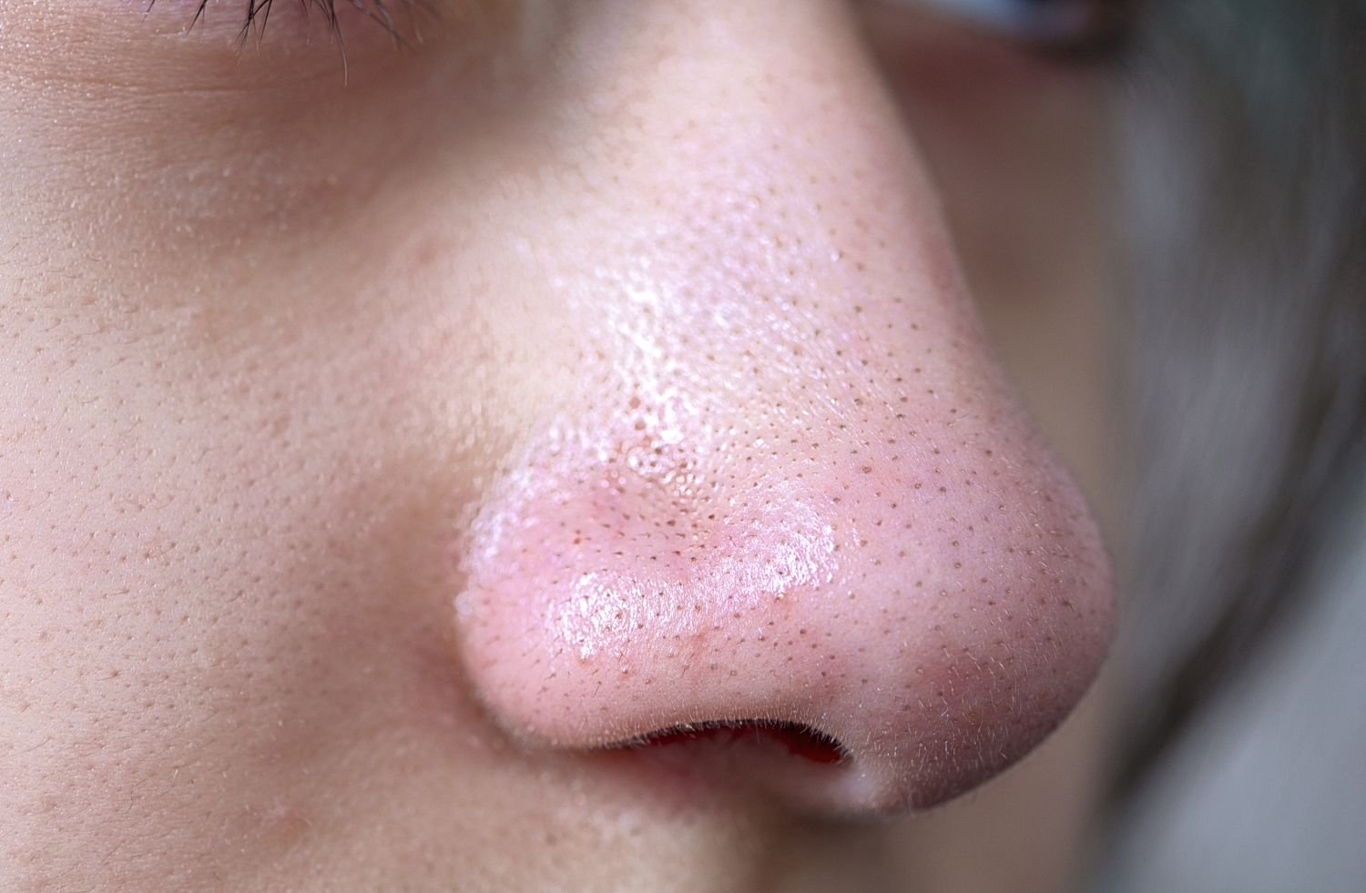 blackhead removal in jaipur