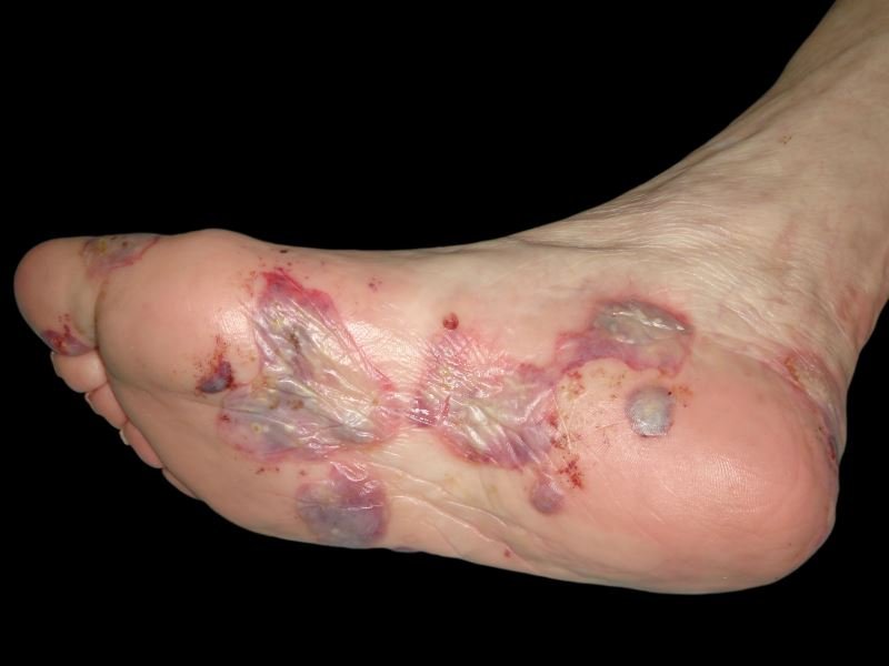 Bullous Pemphigoid treatment in jaipur