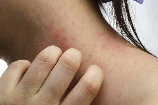 Drug Rash treatment in jaipur