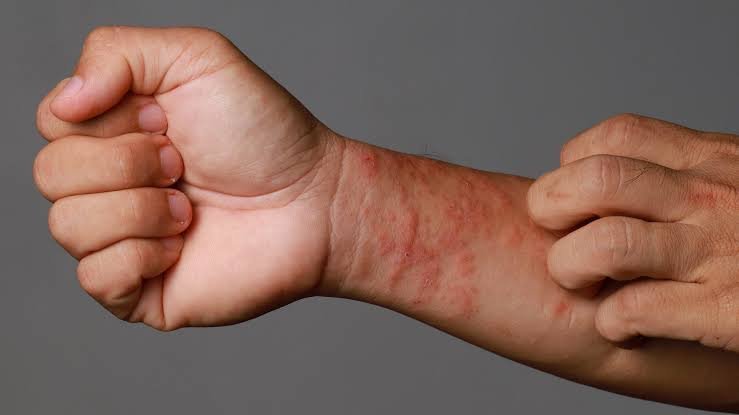 Eczema Treatment in Jaipur