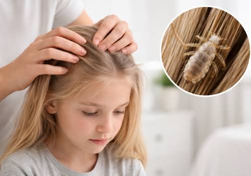 Head Lice Treatment in Jaipur