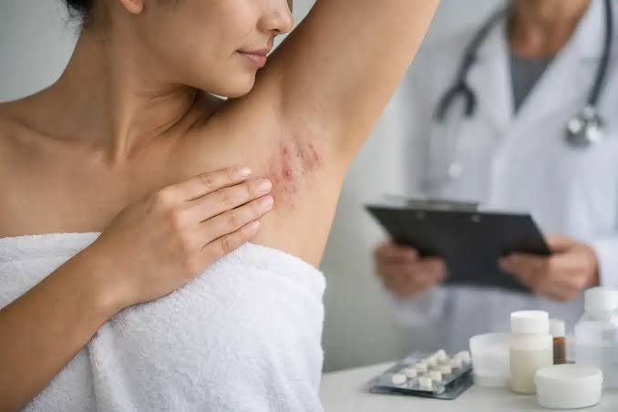 Hidradenitis Treatment in Jaipur