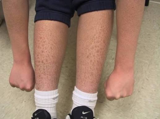 Ichthyosis Vulgaris treatment in jaipur