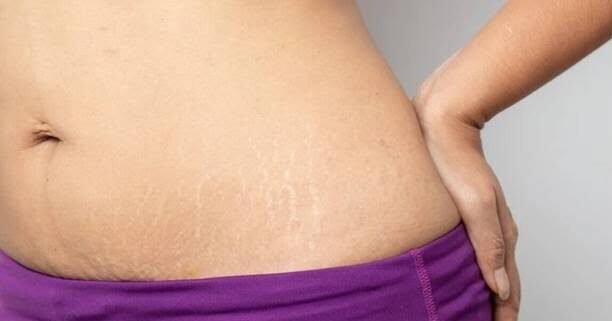 STretch mark treatment in jaipur