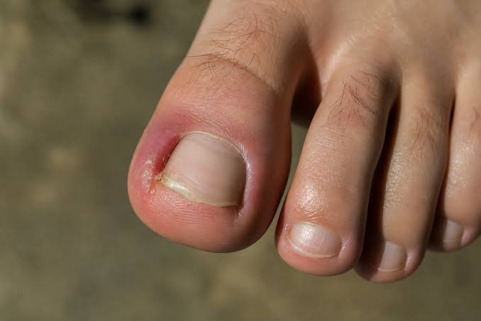 Ingrown Toe Nail Surgery in Jaipur