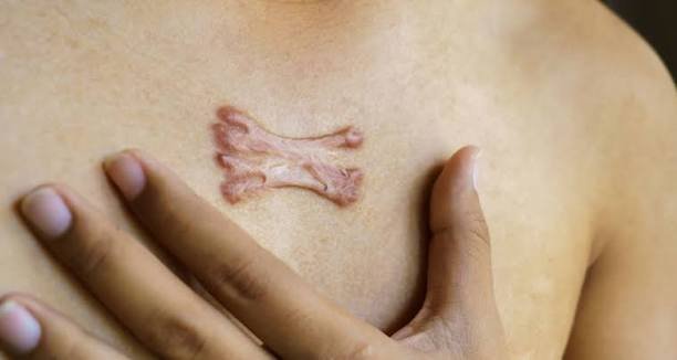 Keloid Treatment in Jaipur