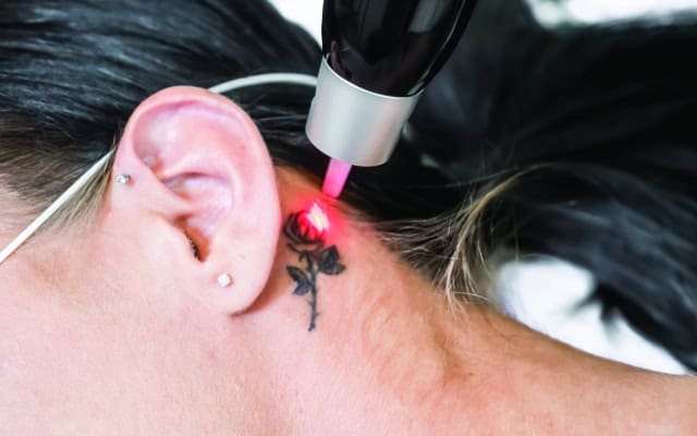 laser tattoo removal jaipur