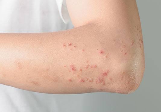 Lichen Planus Treatment in Jaipur