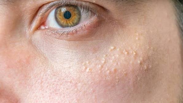 Milia Removal in Jaipur