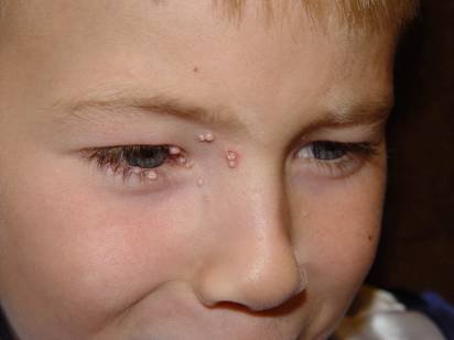 Molluscum Contagiosum treatment