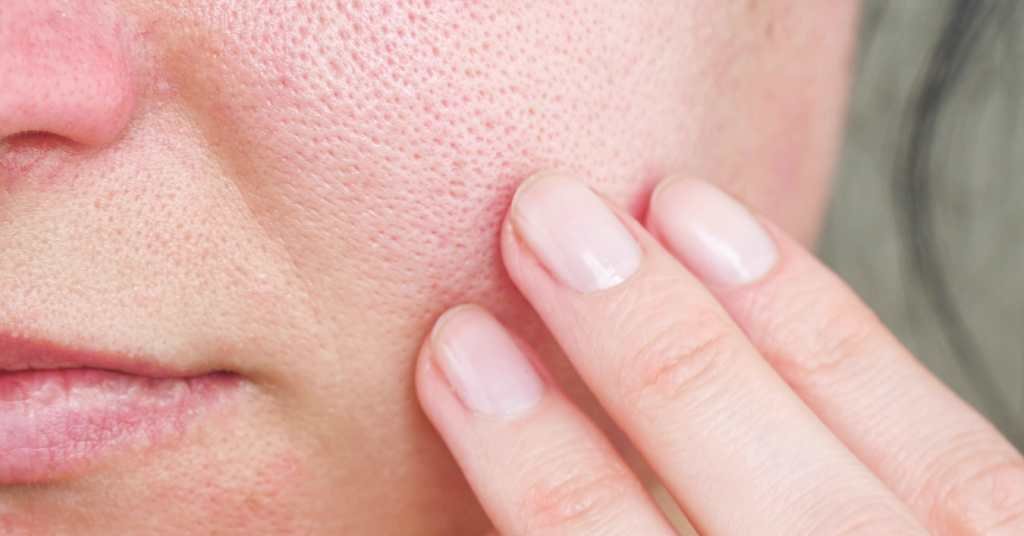open pore treatment in jaipur