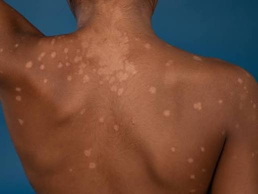 Pityriasis versicolor treatment jaipur