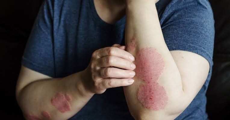 psoriasis treatment in jaipur