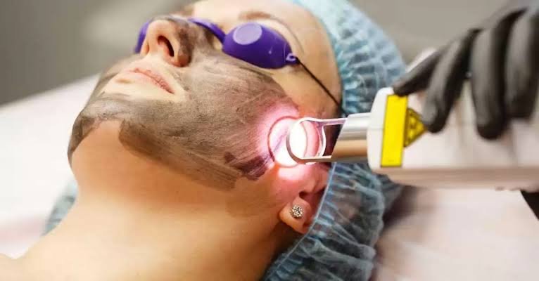 Q Switch laser treatment jaipur