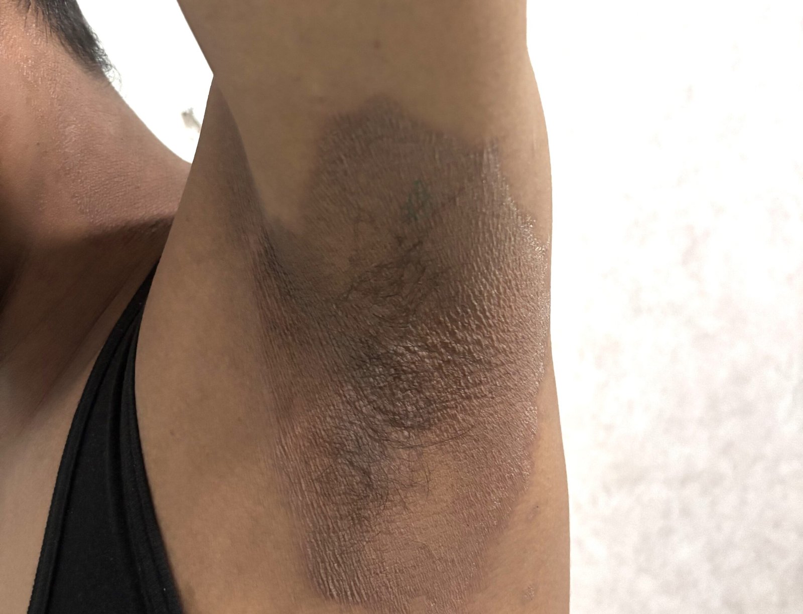 Ringworm infection treatment in jaipur