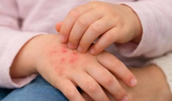 scabies treatment IN Jaipur