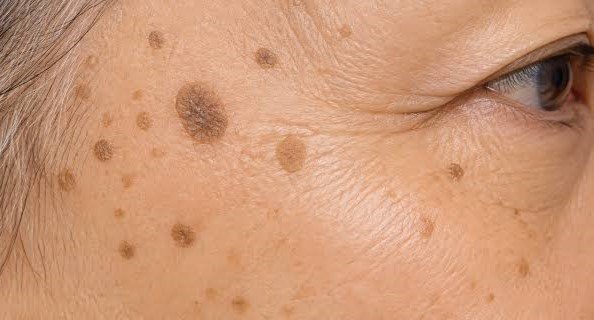 seborrheic keratosis treatment in jaipur