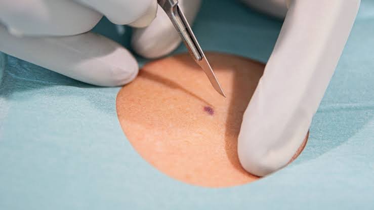 Skin Biopsy in Jaipur