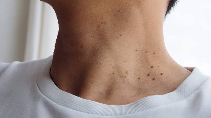 Skin Tags Treatment in jaipur
