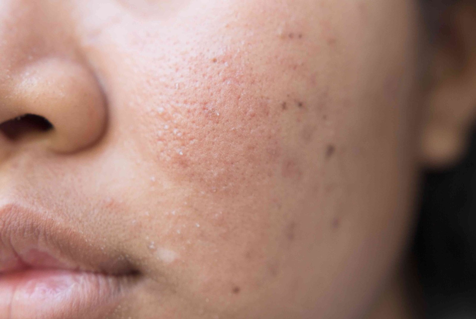Uneven Skin Tone treatment in Jaipur