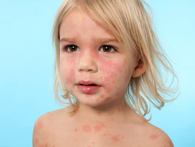 urticaria treatment IN jaipur