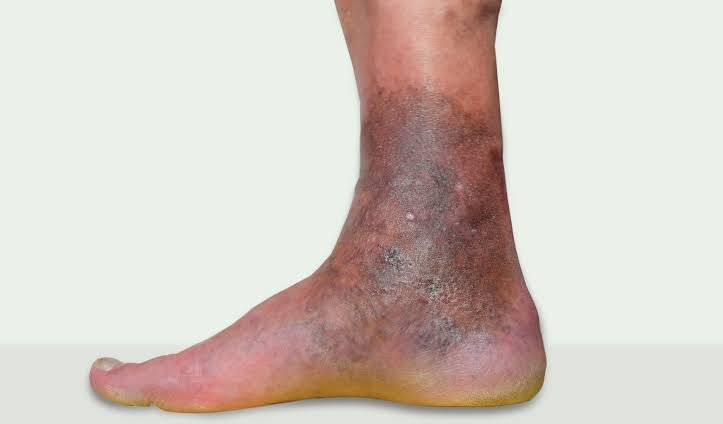 Varicose Eczema treatment in Jaipur