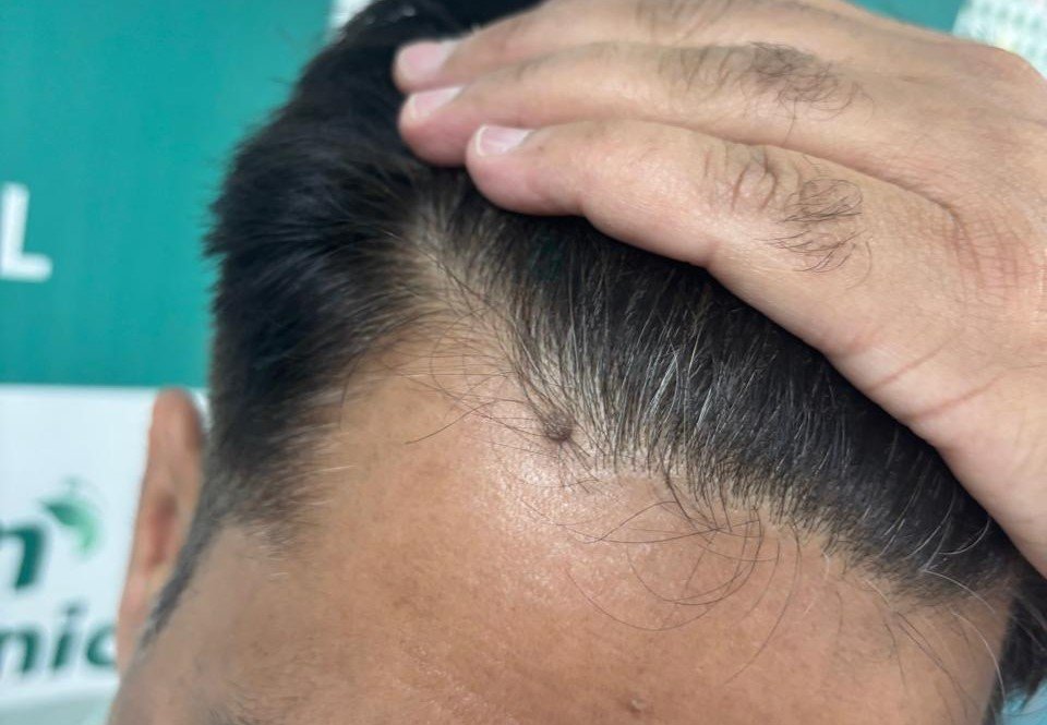 Wart Treatment in Jaipur