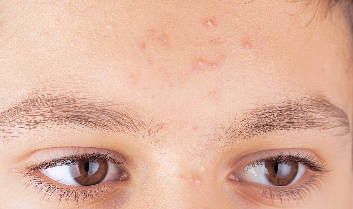 Whitehead Treatment in Jaipur